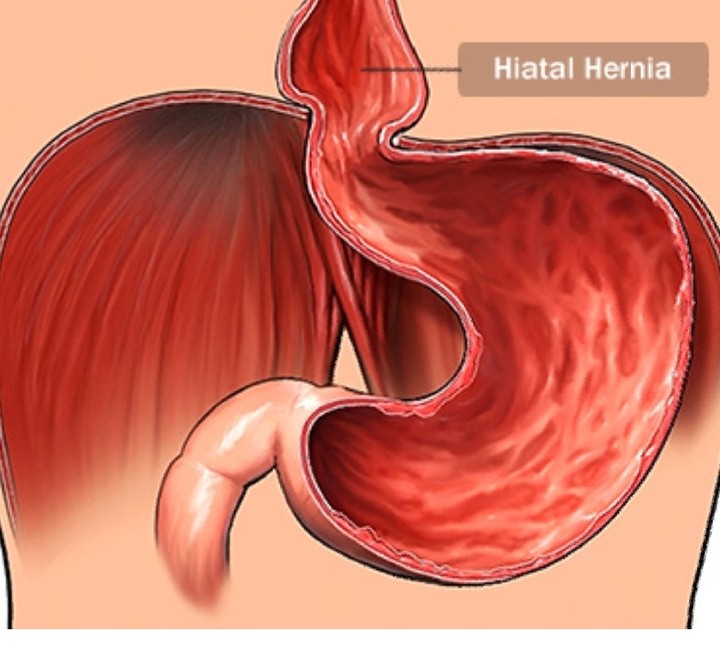 Exploring Hiatal Hernia What You Should Know