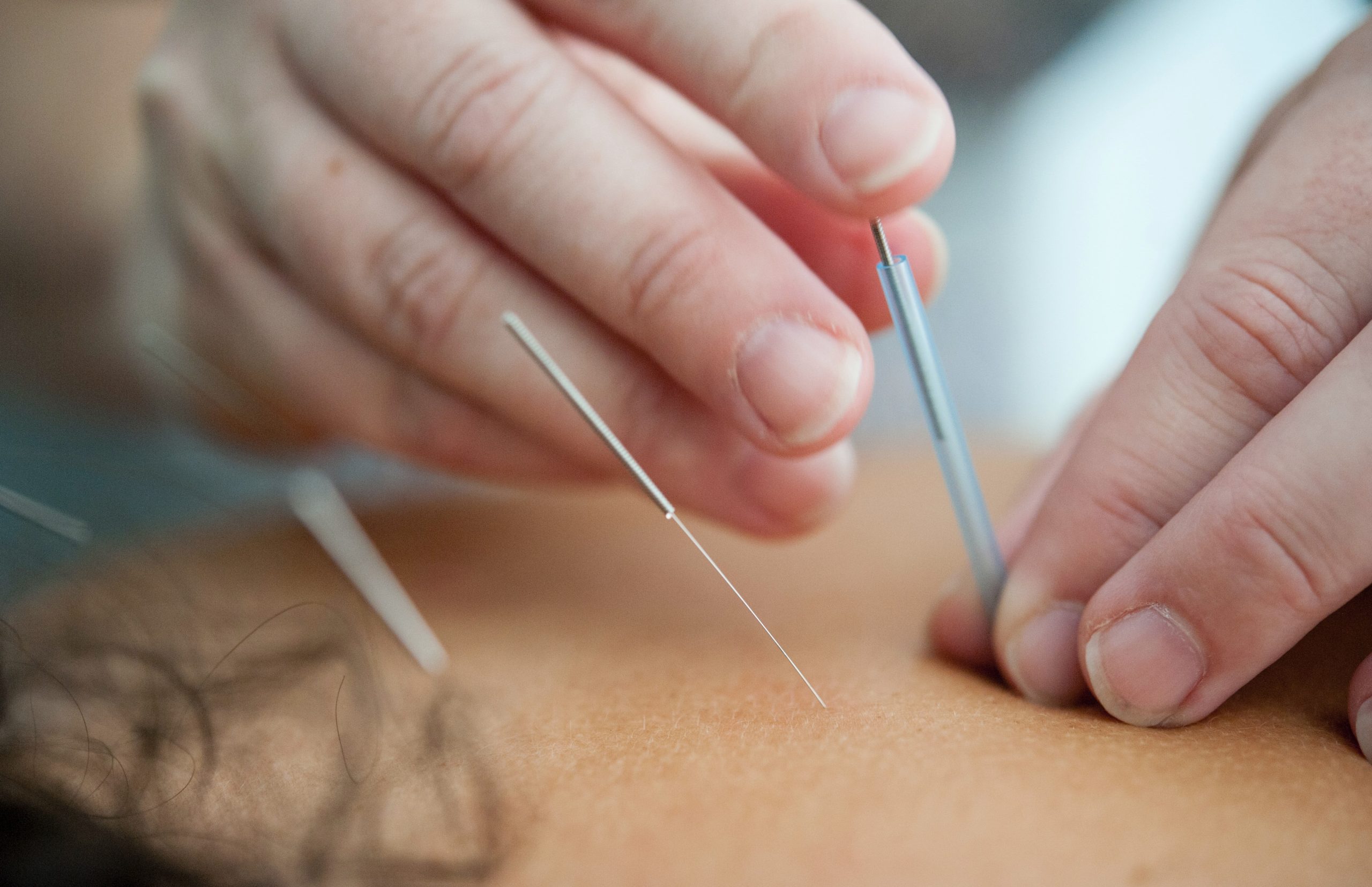 Needles and Healing: How Acupuncture Can Help Relieve Chronic