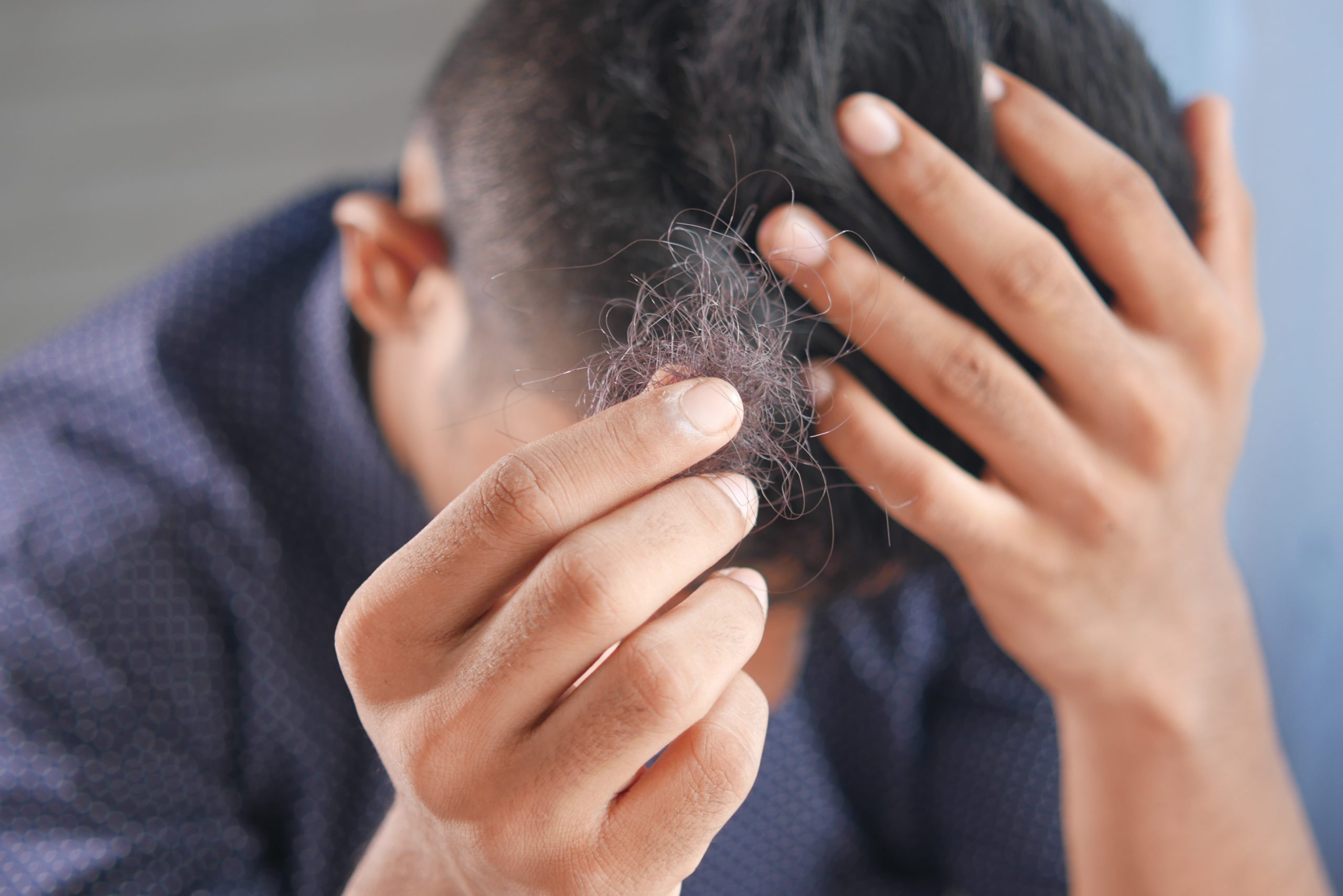 A Look at the Latest Hair-Loss Treatments