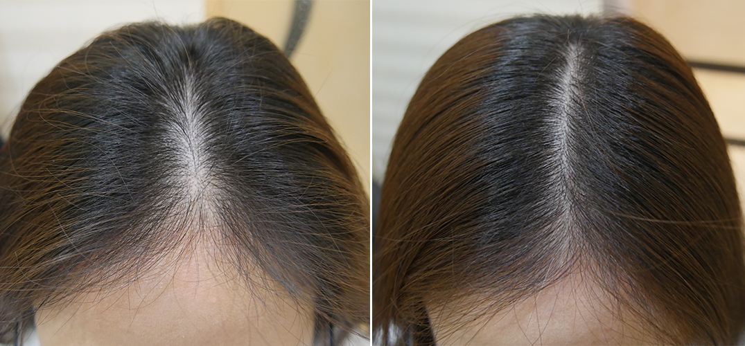 Quick Act for Quick Results, Solution for Hair Loss