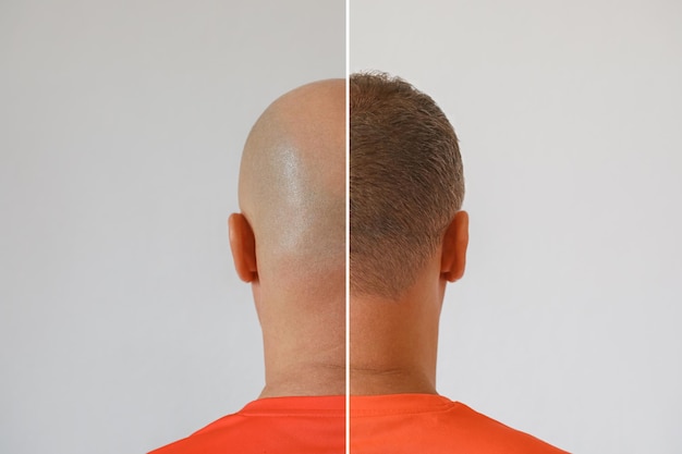 Surprising Hair Transplant Costs! It’s Not As Expensive As You Might Think!