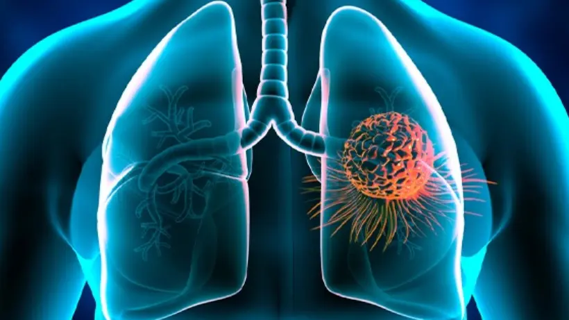 Lung Cancer: Diagnosed and Cured in a Single Day Success