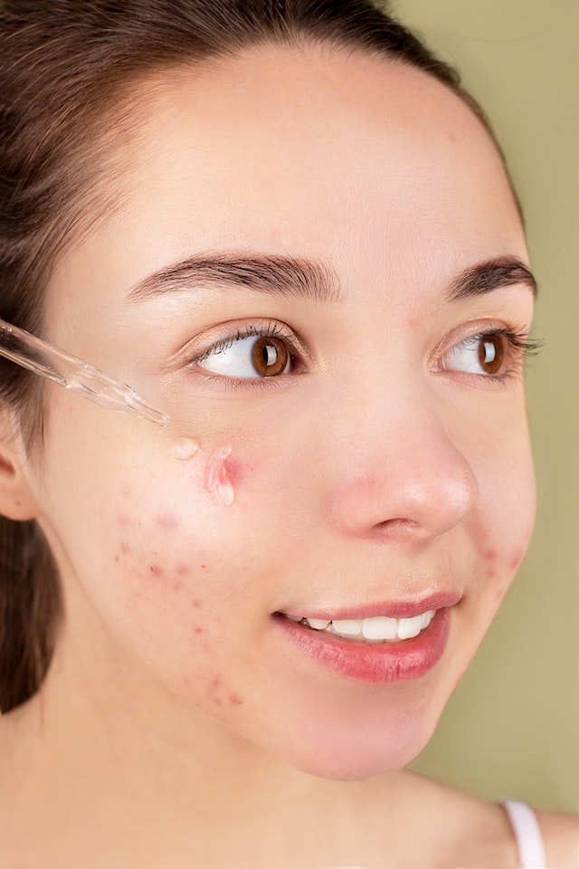 Acne-Proof Your Wallet: 15 Low-Cost Tips for Banishing Pimples