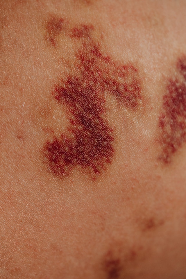 The ultimate guide to treating bruises with household ingredients