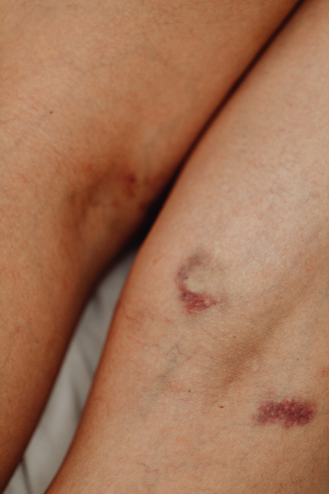 Effective Tips for Healing Bruises on Your Own