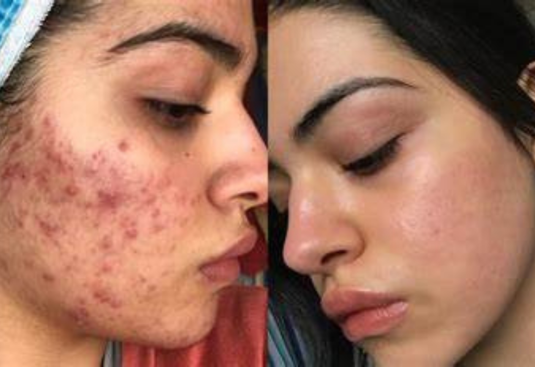 Forget Costly Acne Treatments : Discover the ‘Miracle Cure’ You’ve Been Waiting For!