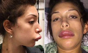 lip filler