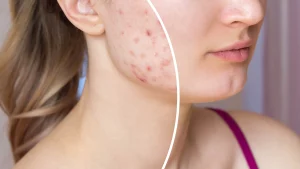 Mastering Acne