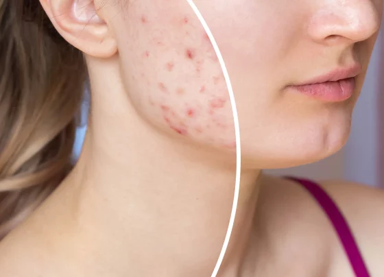 Mastering Acne