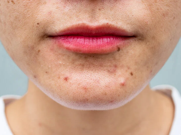 Effective Acne Treatment and Remedies for Clearer Skin