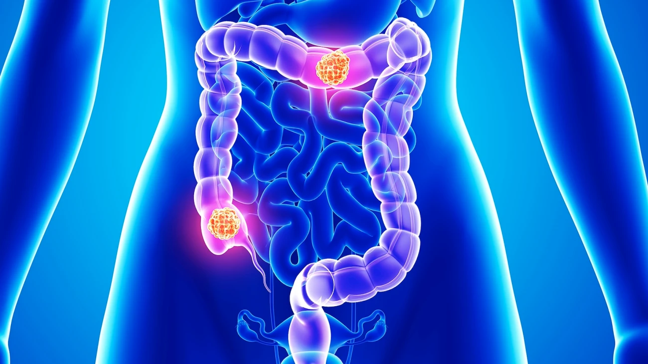 Investigating the Rise of Colorectal Cancer in Young Adults