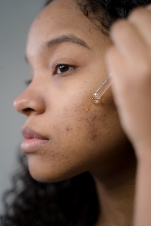Crafting an Effective Skincare Routine for Acne-Free Skin