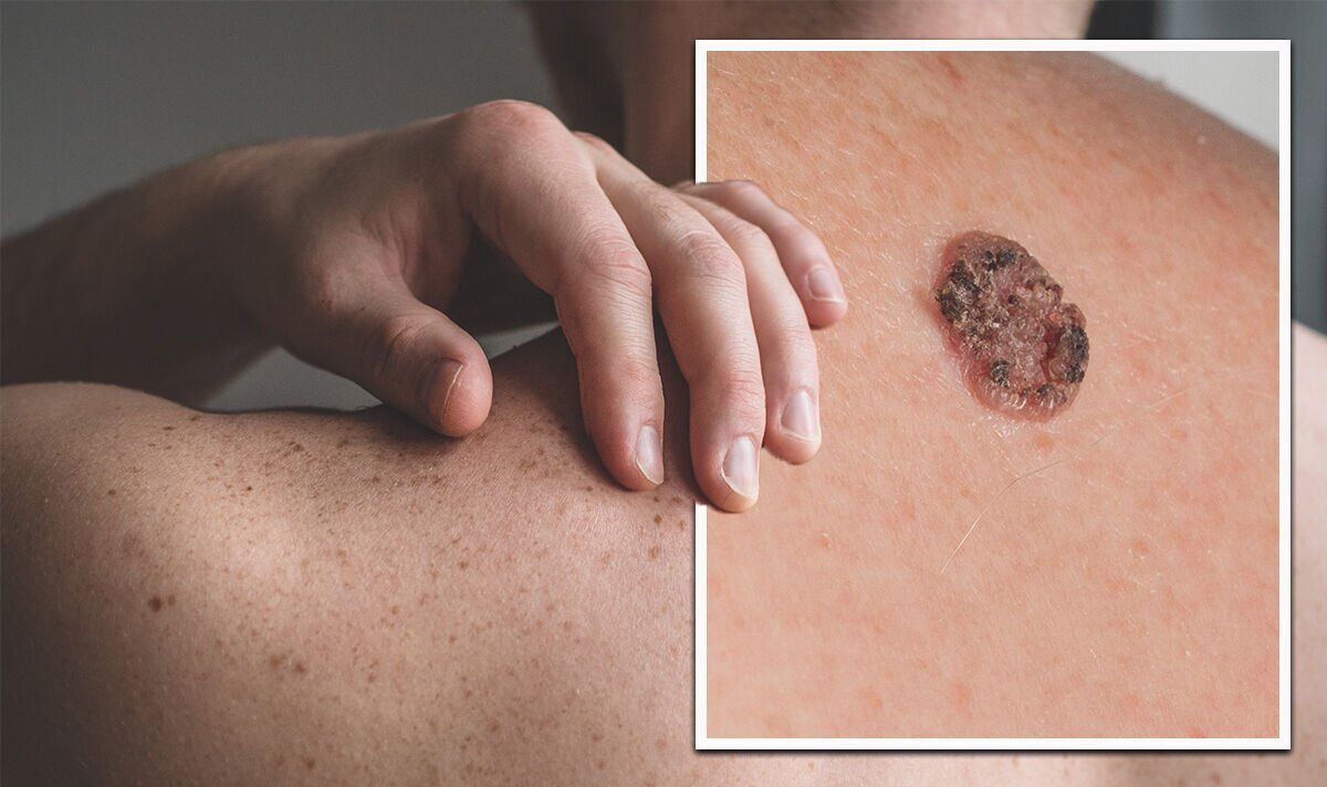 Skin Cancer Exposed: Recognizing the Telltale Signs on Your Skin