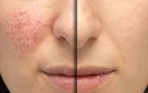 Rosacea Remedies