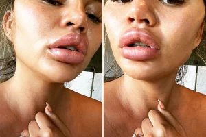 Dissolve Lip Fillers