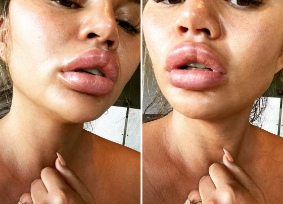 Dissolve Lip Fillers