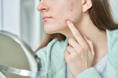 Eliminate Pimple and Acne Redness Effectively