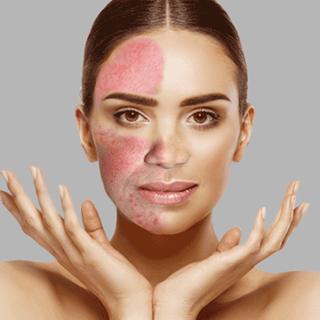 DIY Rosacea Remedies: Transforming Your Home into a Haven