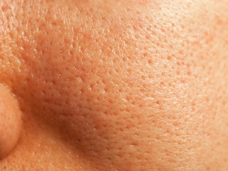 Natural Ways to Shrink Open Pores