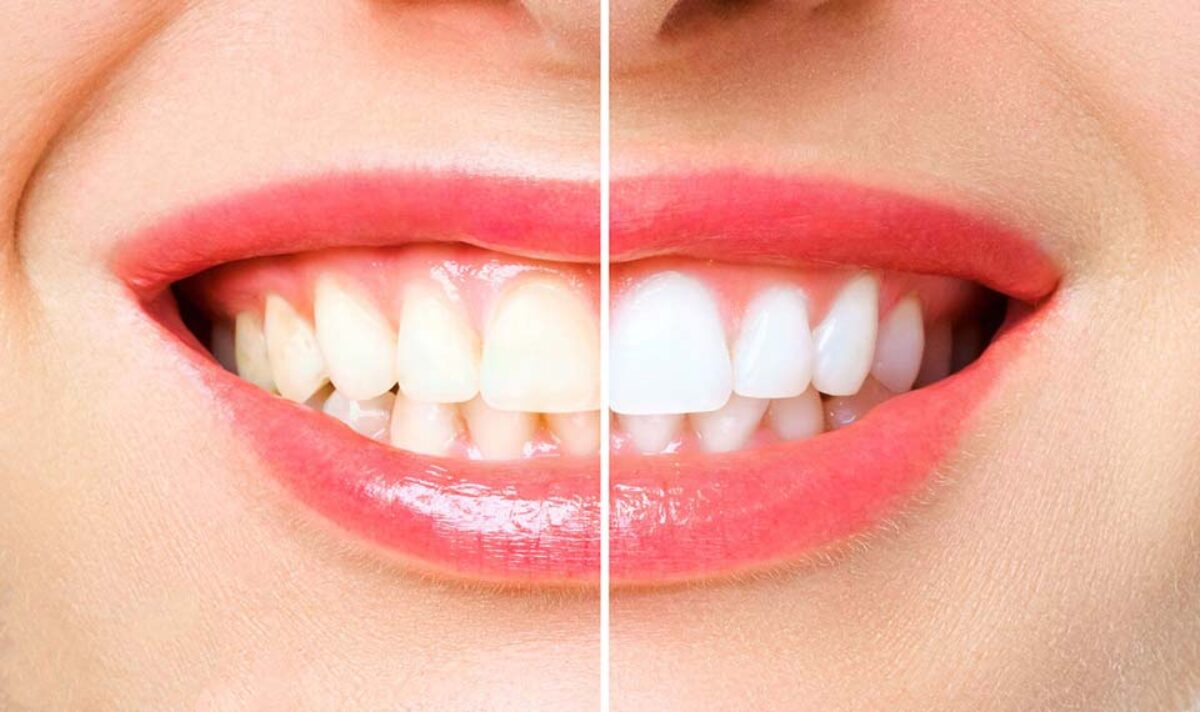 Natural Ways to Whiter Teeth