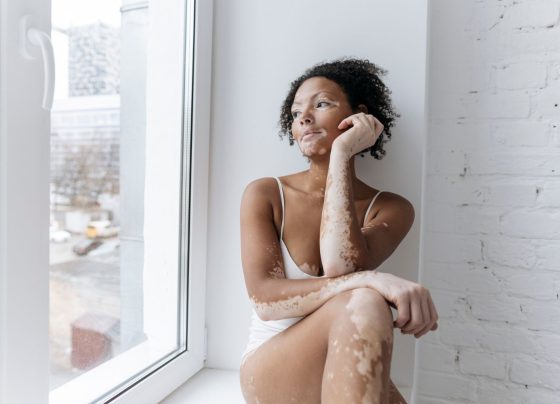 Vitiligo Prevention