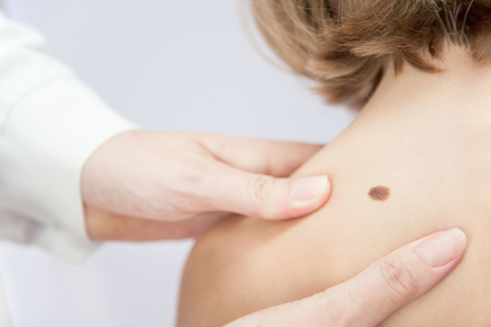 Unblemished Journey: Safely Removing Your Birthmark