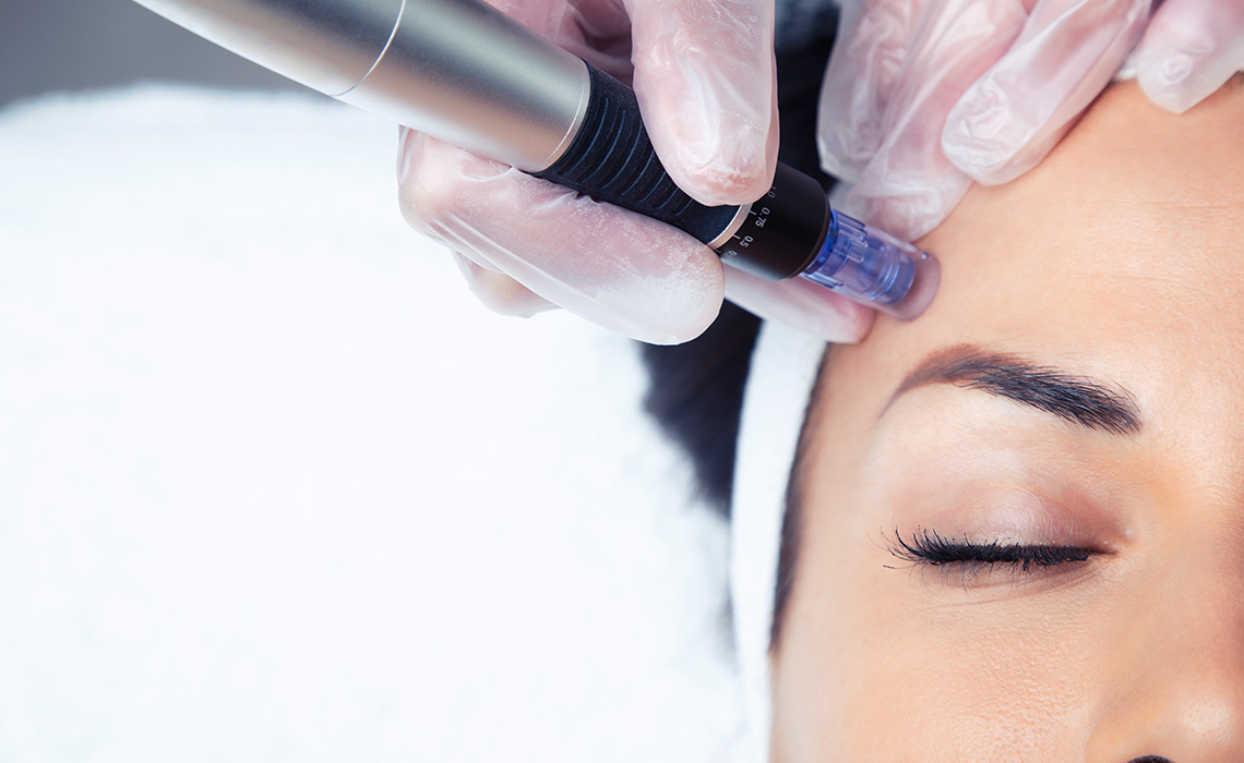 Pinning Perfection: Microneedling’s Pros and Cons Exposed