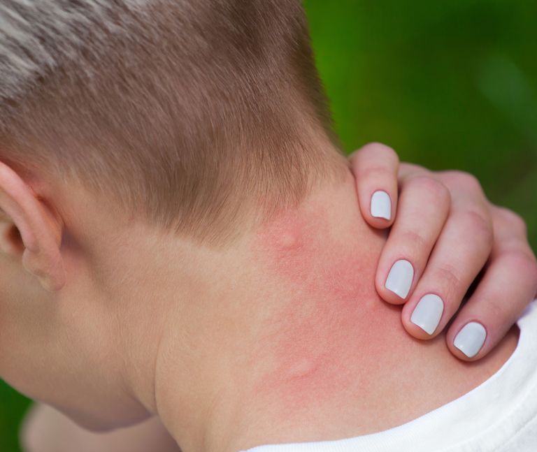 DIY Bite Bliss: 5 Quick Home Remedies to Relieve Mosquito Itch