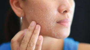  Dry Peeling Skin