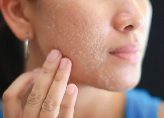 Dry Peeling Skin