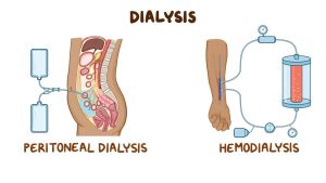 Dialysis Types