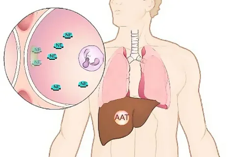 AAT Deficiency: Basic Facts About This Condition