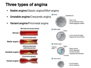 Angina 