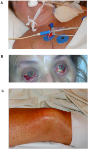 Lujo Hemorrhagic Fever