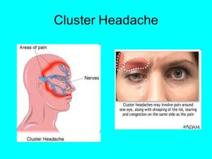 Cluster Headaches