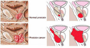  prostate cancer