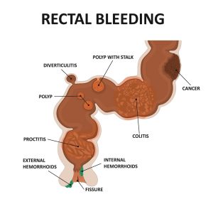 Rectal Bleeding