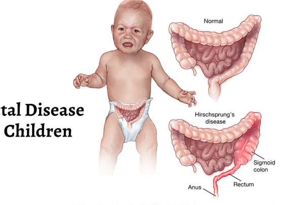 Rectal Bleeding in Children