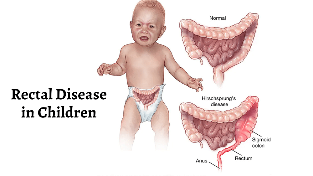 Rectal Bleeding in Children