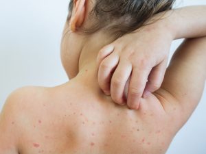  Roseola Infections 