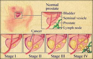  prostate cancer