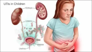 Urinary Tract Infection