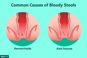 Rectal Bleeding