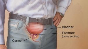  prostate cancer