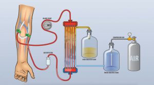 Dialysis Types