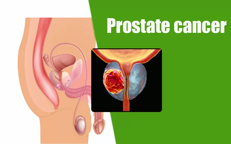 5 Warning Signs of Prostate Cancer