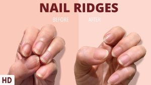 Nail Problems 