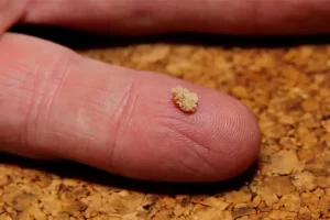 Kidney Stone