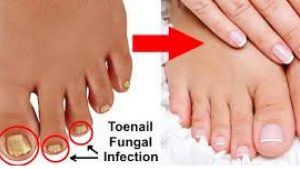 Solving Toenail Troubles