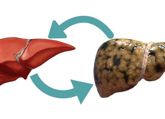 Fatty Liver